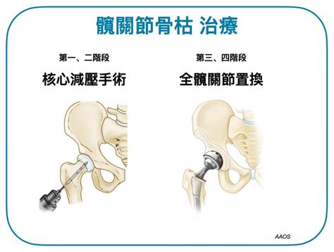 骨枯手術費用|【髖關節手術費用2023】公私營醫院收費參考